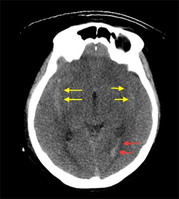 Pure Endovascular Management of an Arteriovenous Malformation and an Aneurysm Both Supplied by Anterio-Inferior Cerebellar Artery: A Case Report and a Review of Literature